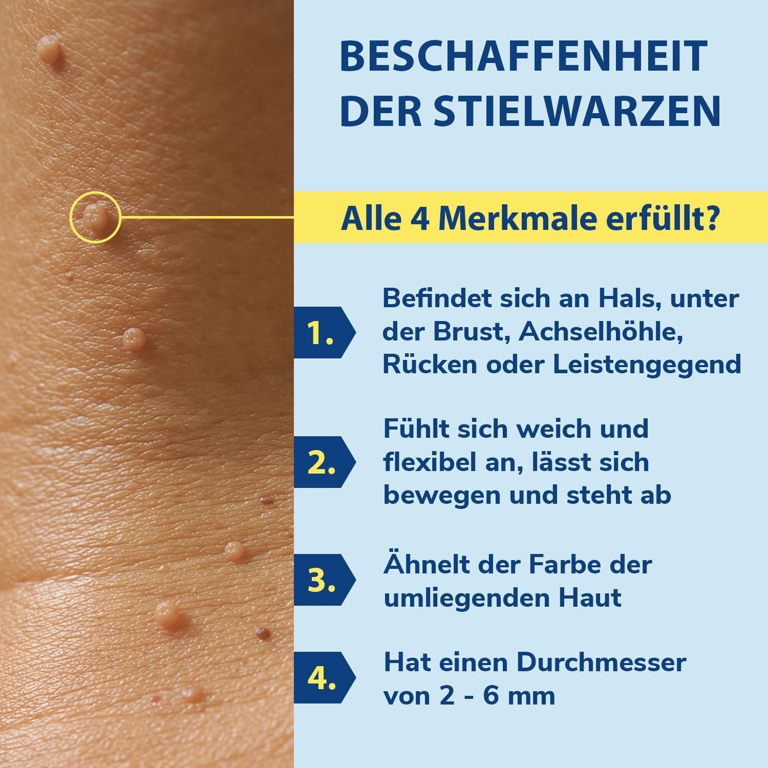 tetesept Stielwarzen Entferner Set