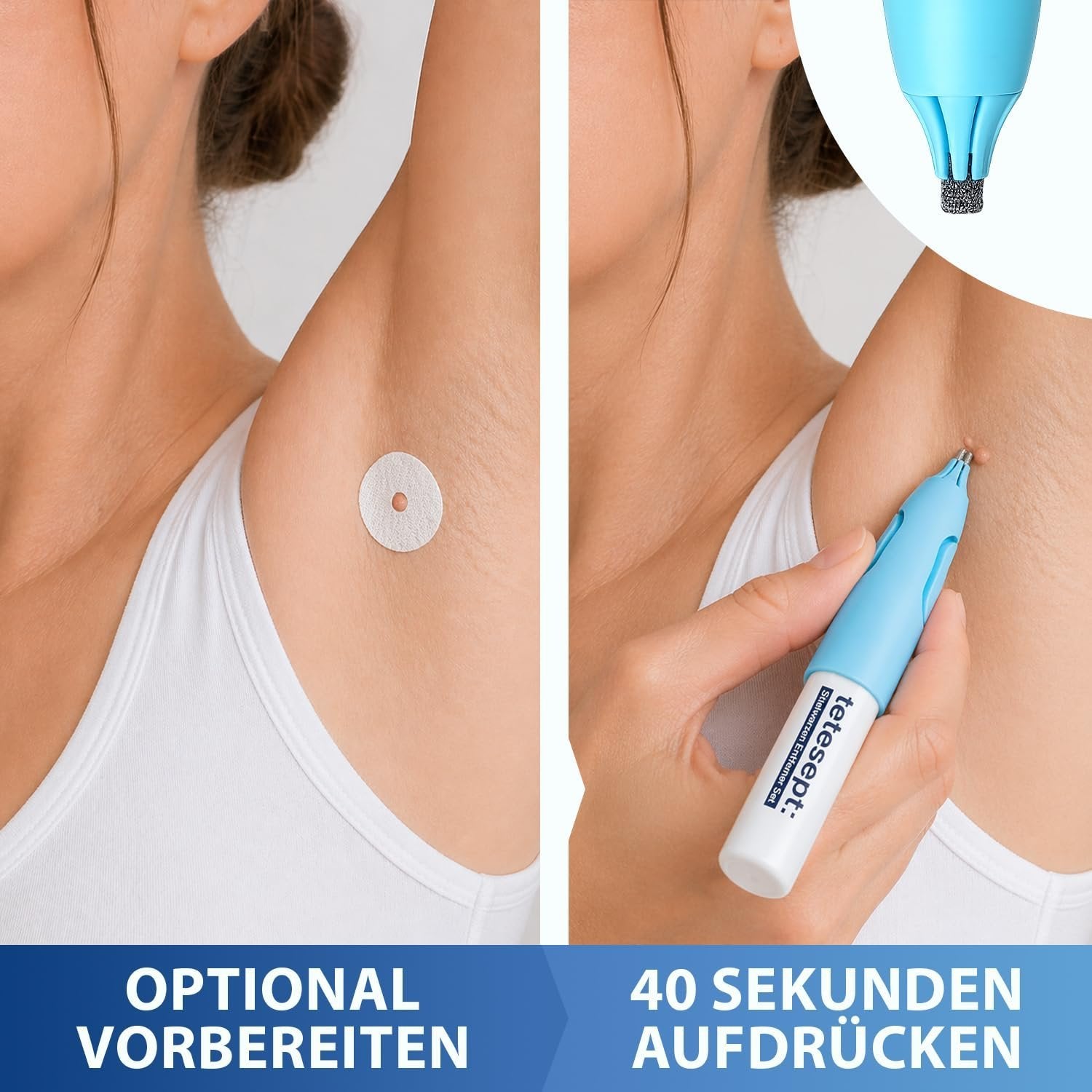 tetesept Stielwarzen Entferner Set